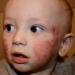 Childhood Eczema Treatment in Colorado Springs