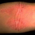 Childhood Eczema in folds of skin treatment in Colorado Springs